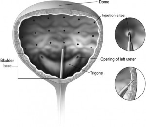 Injection pattern for intradetrusor injections for treatment of overactive bladder and detrusor overactivity associated with spinal cord injury
