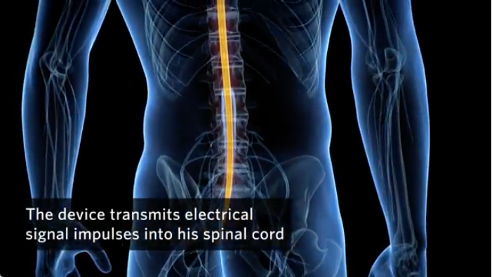 Utilizing a Double Epidural Electrical Stimulation Implant For SCI