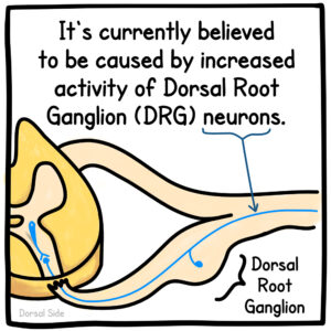 It's currently believed to be caused by increased activity of Dorsal Root Ganglion (DRG) neurons.