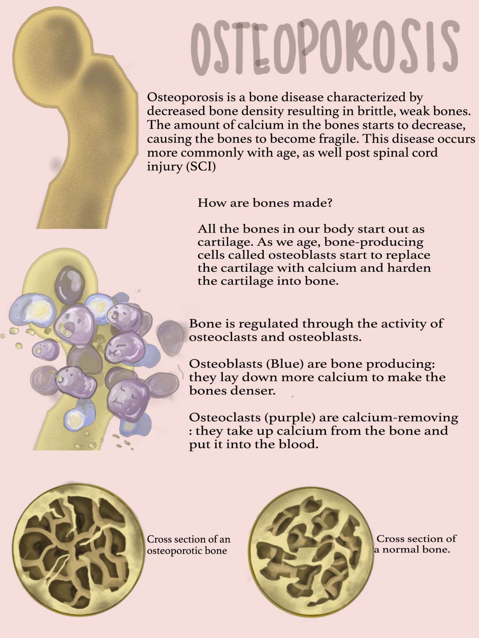 Osteoporosis after spinal cord injury ICORD