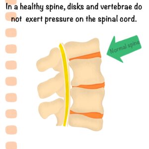 What Is Myelopathy? (Web Illustration) | ICORD