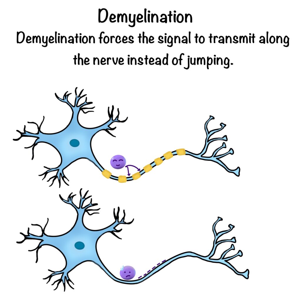 What Is Demyelination? (Web Illustration) | ICORD