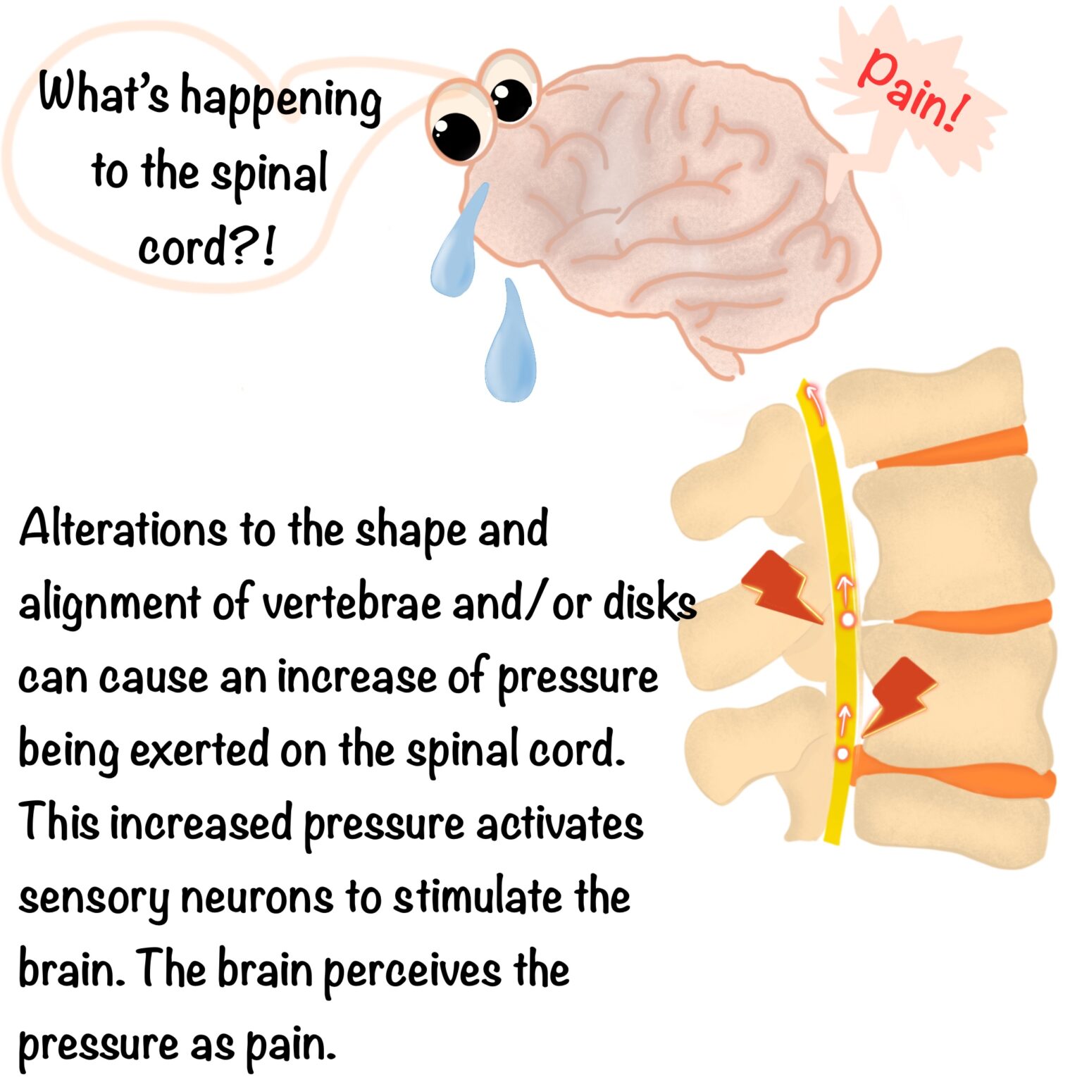 What Is Myelopathy? (Web Illustration) | ICORD